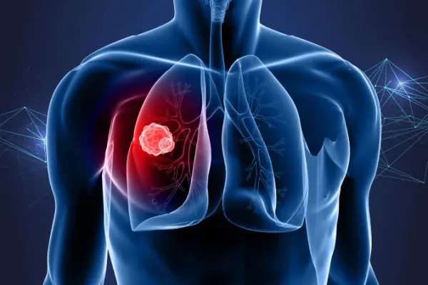 Lung Cancer: A Silent Global Crisis